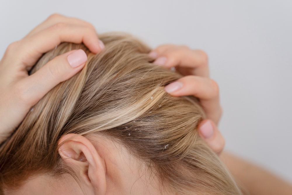 Schuppen loswerden mit Rotlichttherapie: Natürliche Lösung für eine gesunde Kopfhaut
