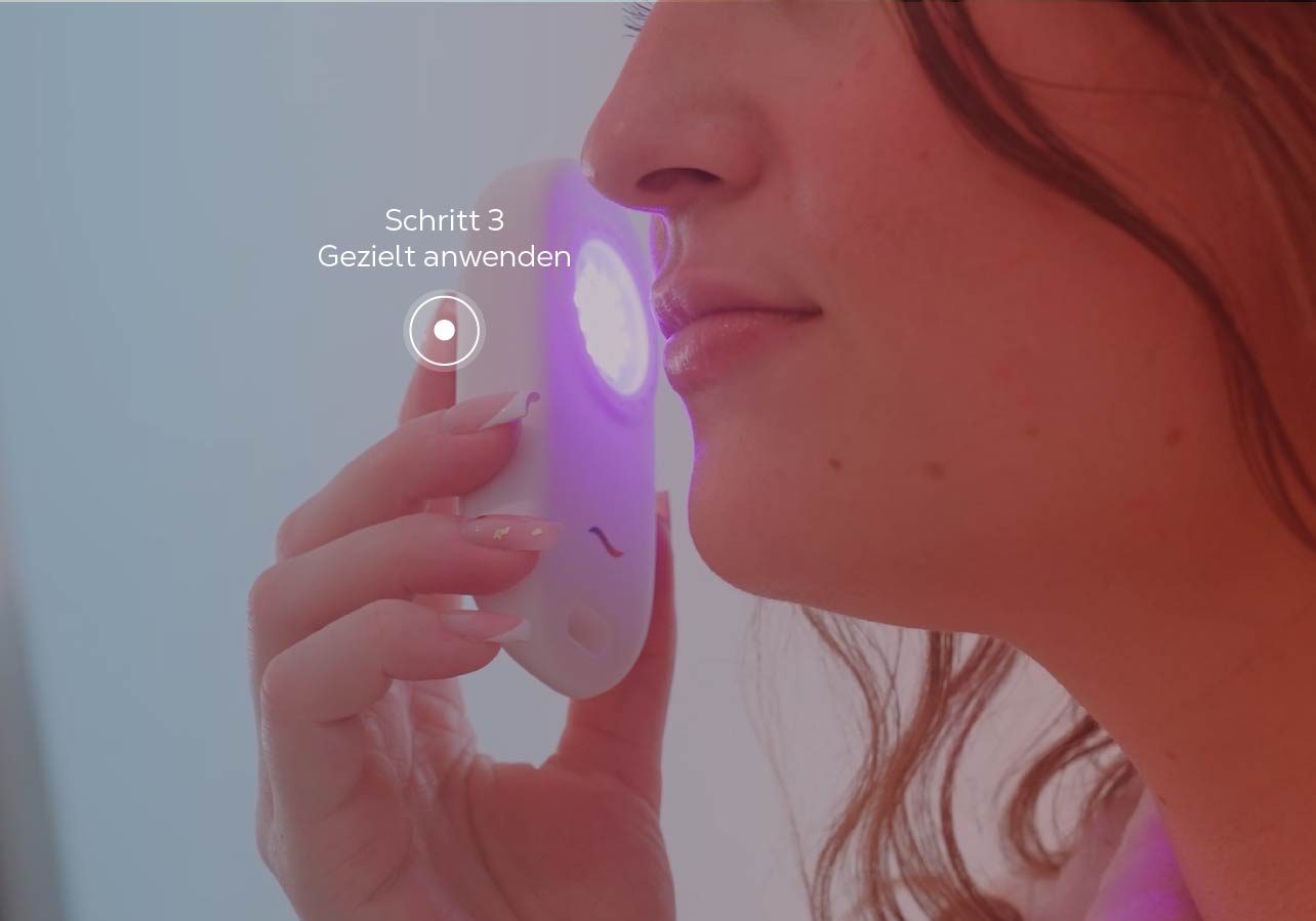 Trattare in modo mirato singole imperfezioni con la luce blu